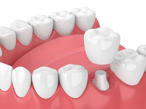 a 3d render of a jaw with full set of teeth and sample dental crown cap