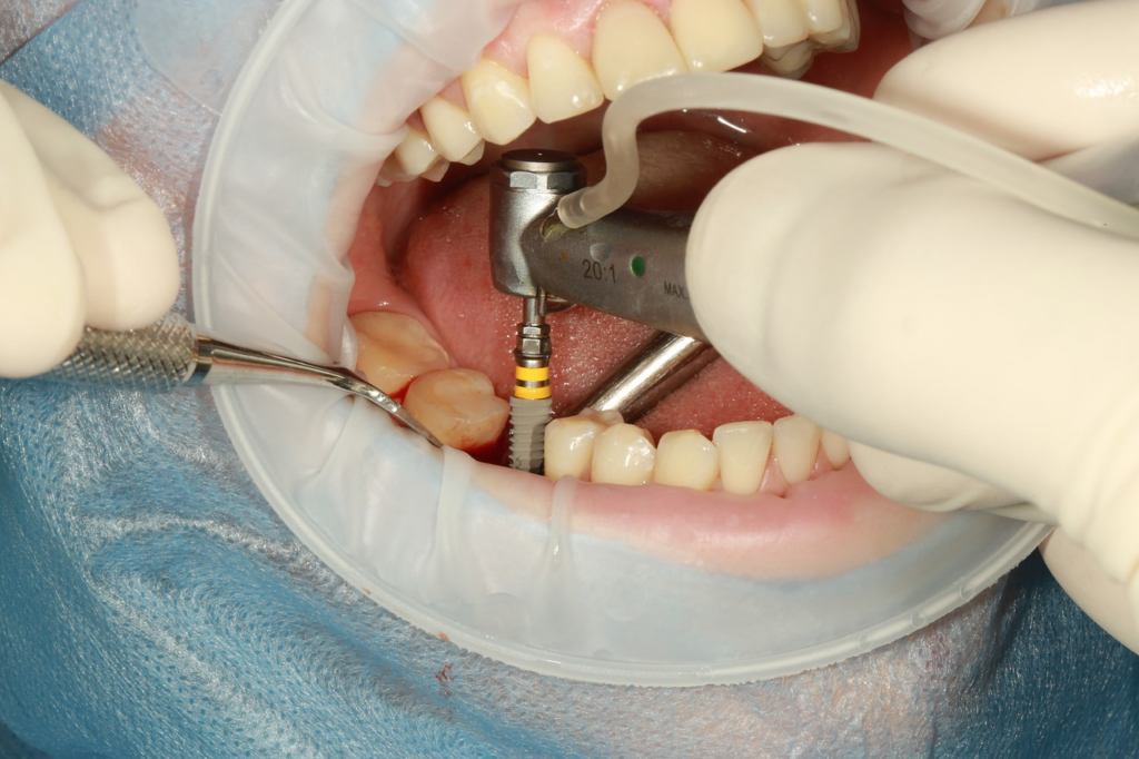 photo showing the installation of a dental implants post