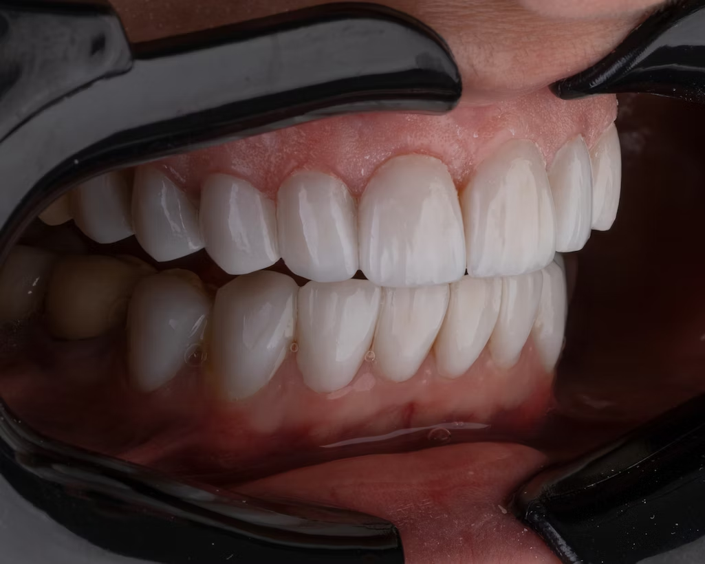 a close-up shot of a person's teeth and gums