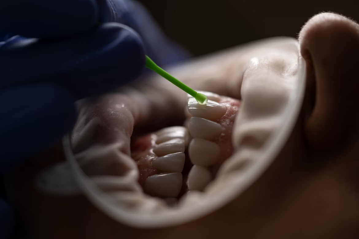 close-up shot of the application of silver diamine fluoride on a patient's tooth
