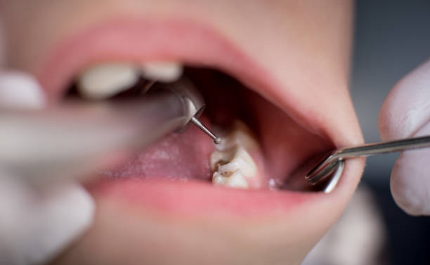 close up shot of a dentist drilling the cavities away with the drilling tool