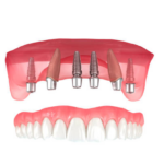 Who Does Dental Implants?
