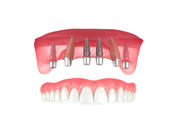 a digital illustration of dental implants