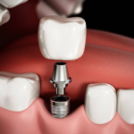 What Do Dental Implants Look Like? Unveiling the Aesthetics of Implant Dentistry
