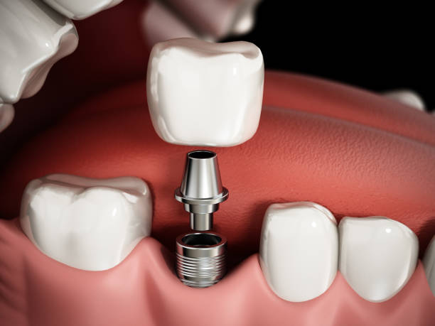 photo showing the different parts of a dental implant