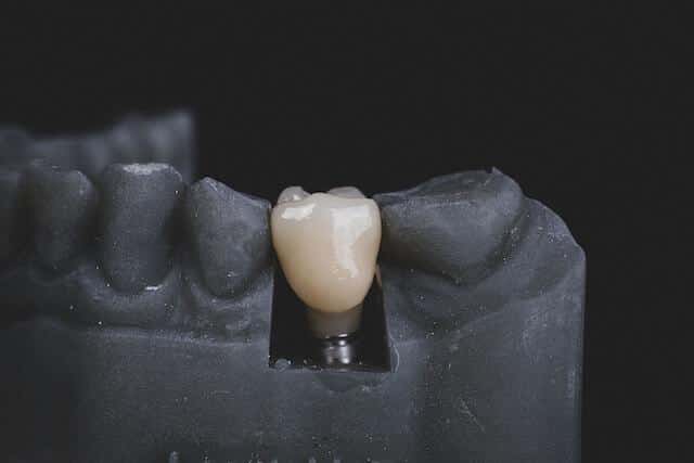 Dental implant crown on a model against black background.