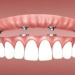 What Are All-on-4 Dental Implants?