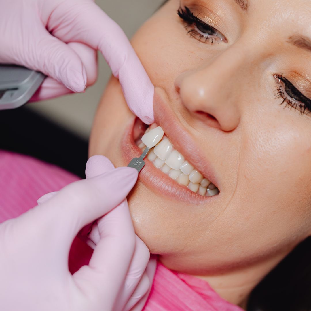 dentists placing porcelain veneers