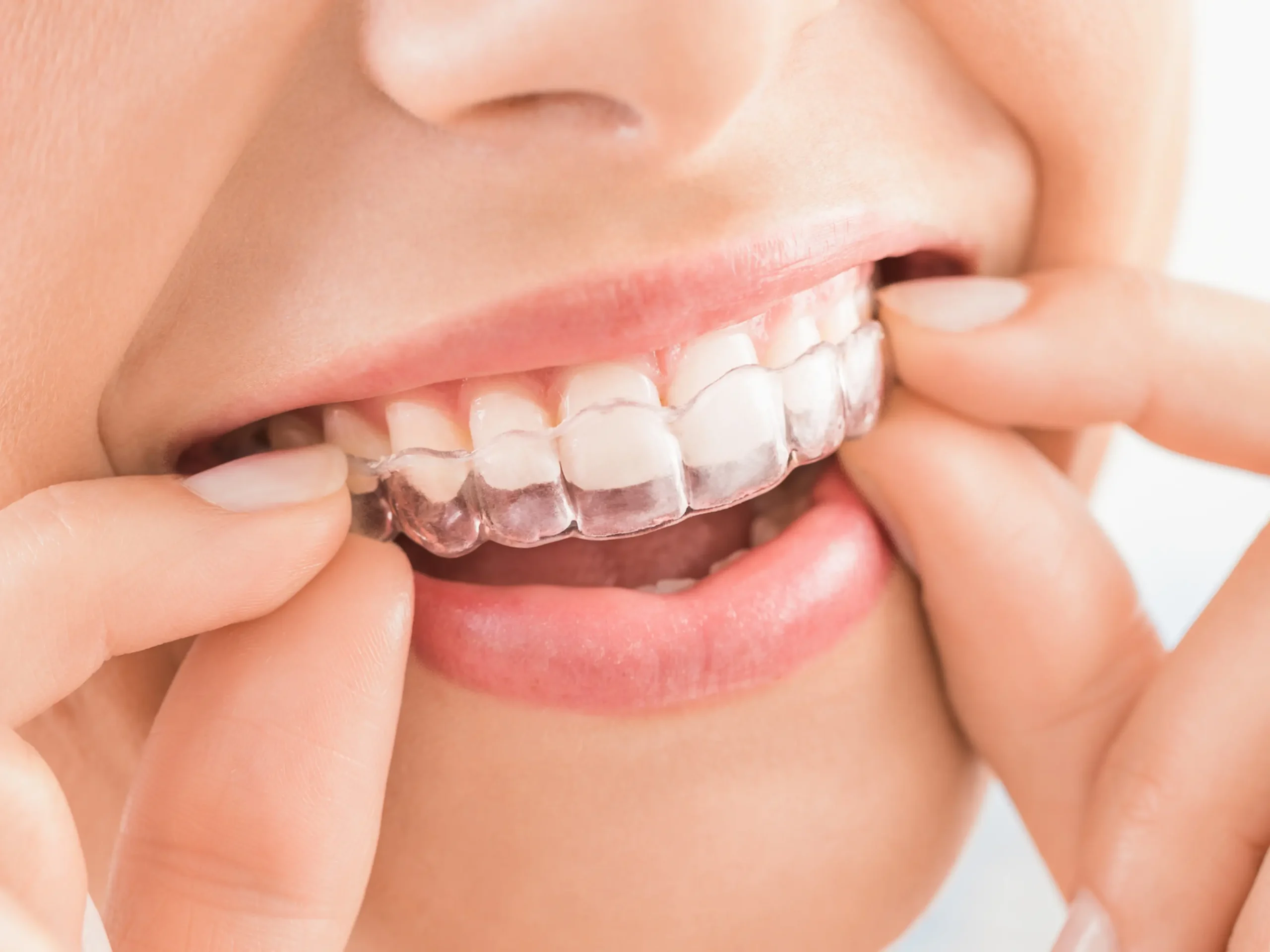 orthodontic issues being addressed by invisalign