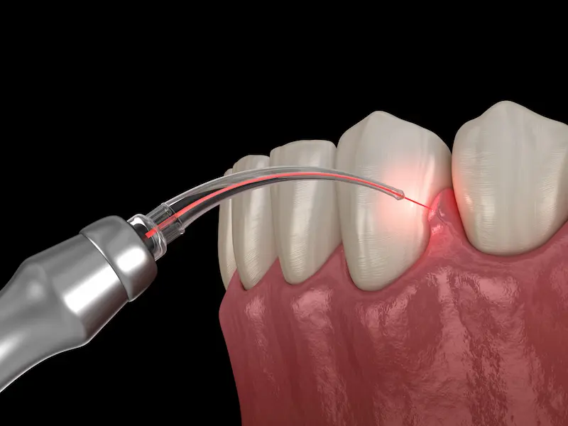 A dental laser Credit: Alexandr Mitiuc - stock.adobe.com Copyright: ©Alexandr Mitiuc - stock.adobe.com